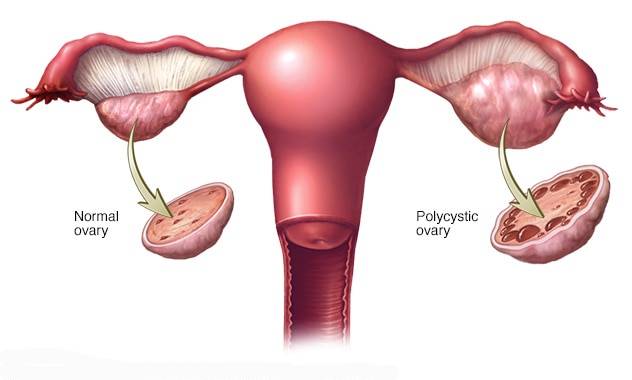 PCOS Treatment in Kolkata